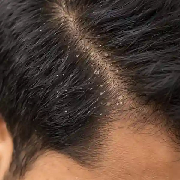 Reduces Dandruff